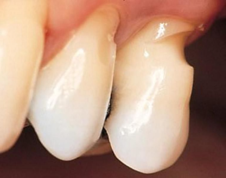 Клиновидный дефект зубов. Лечение клиновидного дефекта